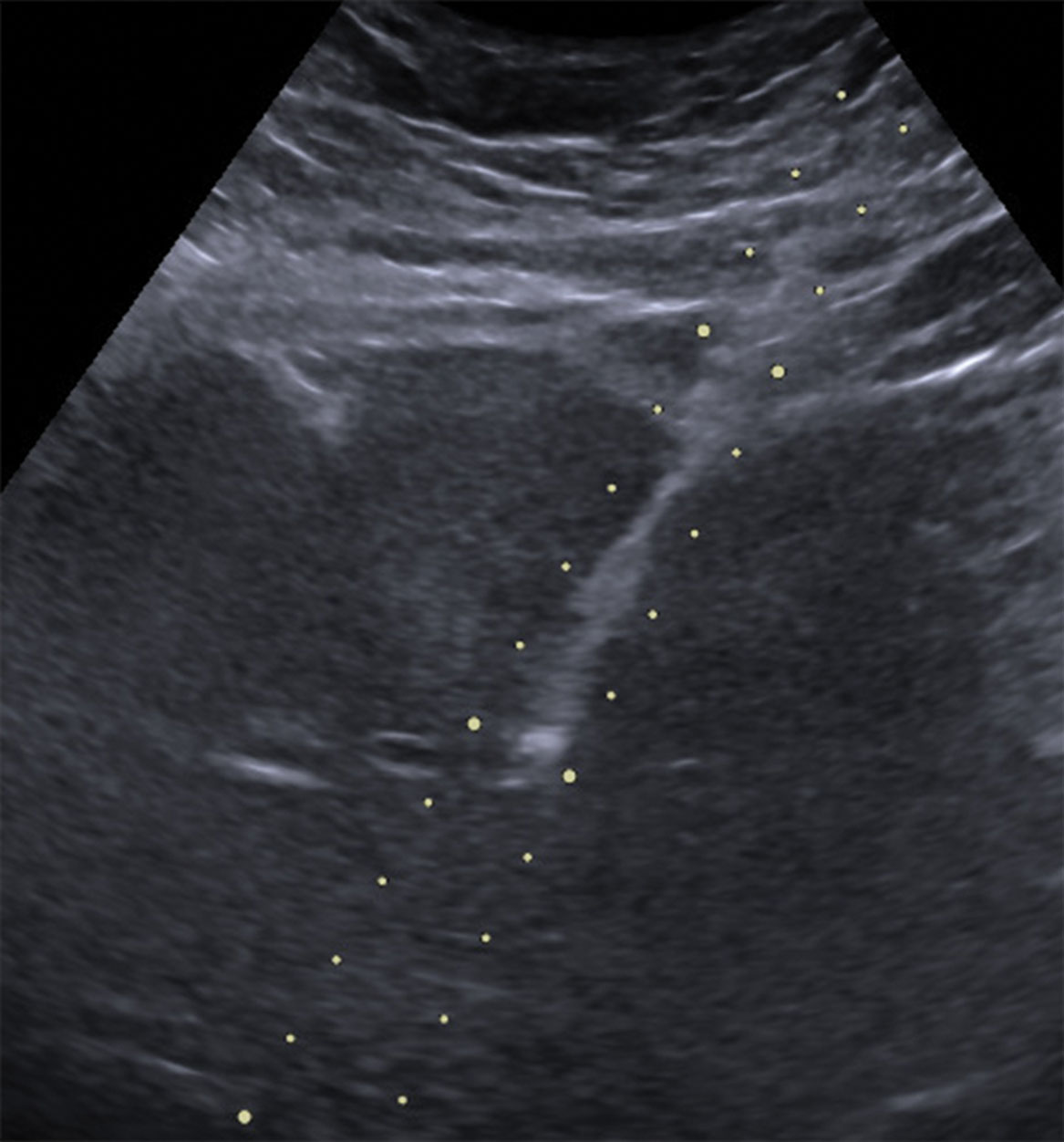 Fig. 18.12, A core biopsy to stage a patient with a fatty liver.