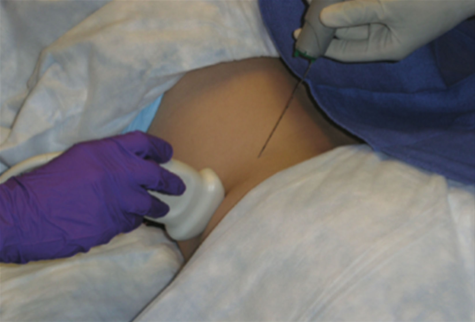 Fig. 18.15, Two-person free-hand technique with the sonographer scanning outside the sterile field.