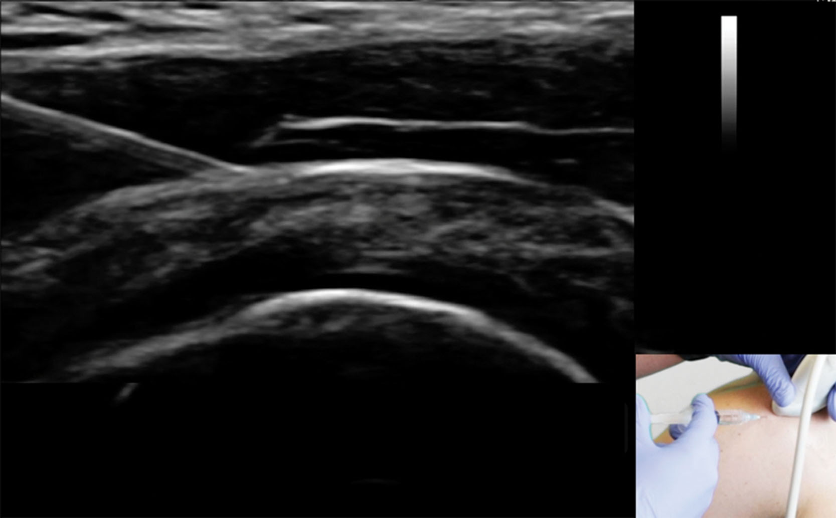 Fig. 18.16, A corticosteroid injection of the shoulder using an in-plane technique.