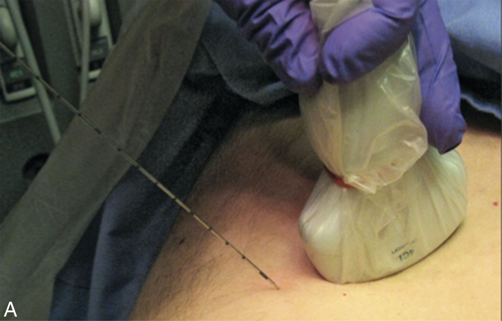 Fig. 18.17, One-person free-hand technique. (A) The needle is not in plane with the transducer, and the needle tip could not be seen. (B) The transducer has now been moved to be in line with the needle.