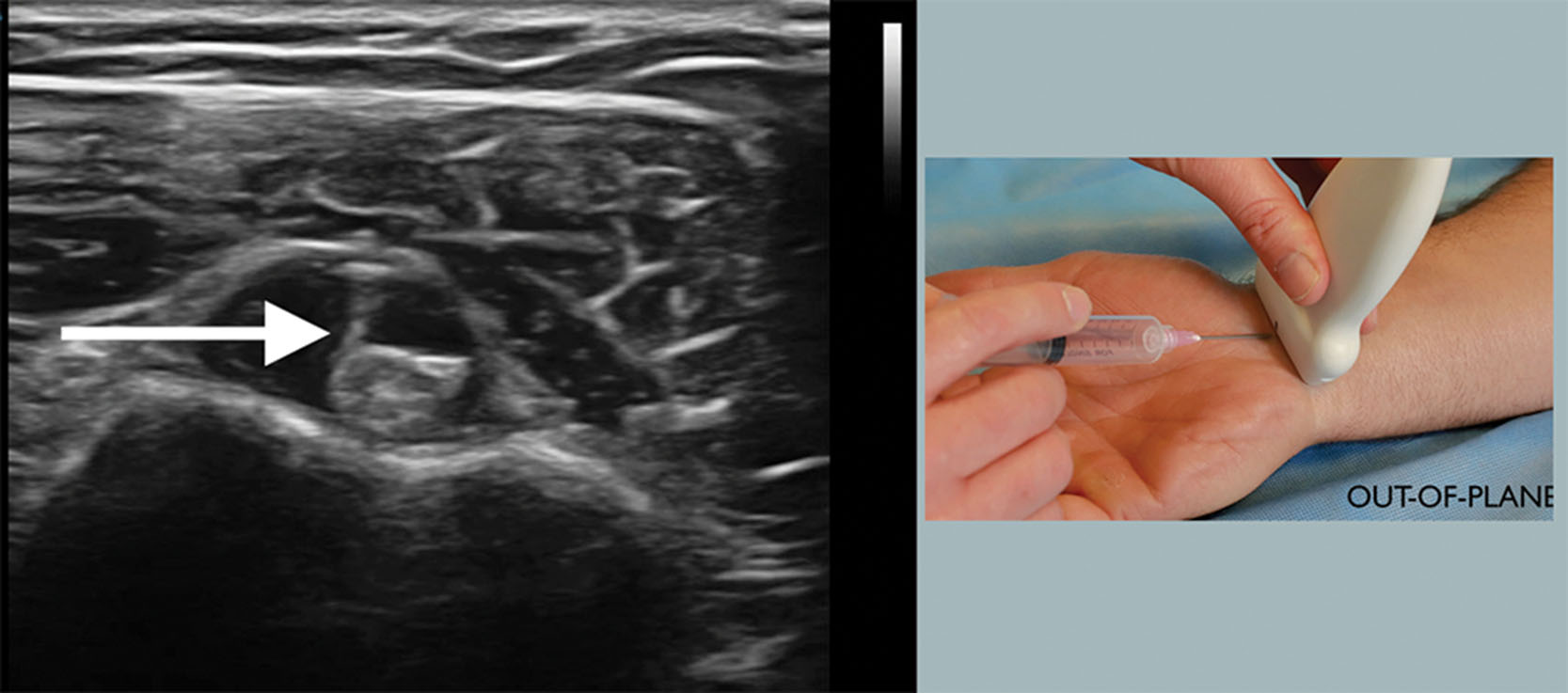 Fig. 18.18, A bicep sheath injection using an out-of-plane technique.
