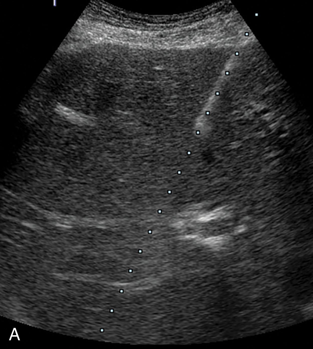 Fig. 18.20, (A) A single line predicted needle path on a liver core biopsy. (B) An example of two lines for the predicted needle path on a patient with metastatic pancreatic liver cancer.