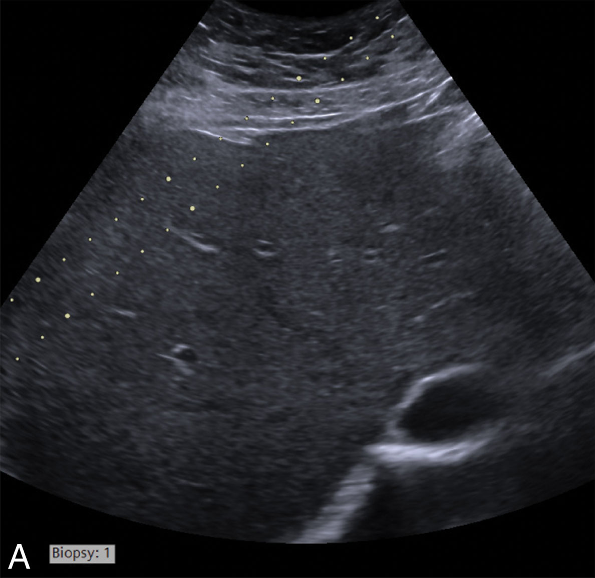 Fig. 18.21, This system offers a choice of five different angles. Biopsy 3 (C) or biopsy 4 (D) would be used for this liver core biopsy.