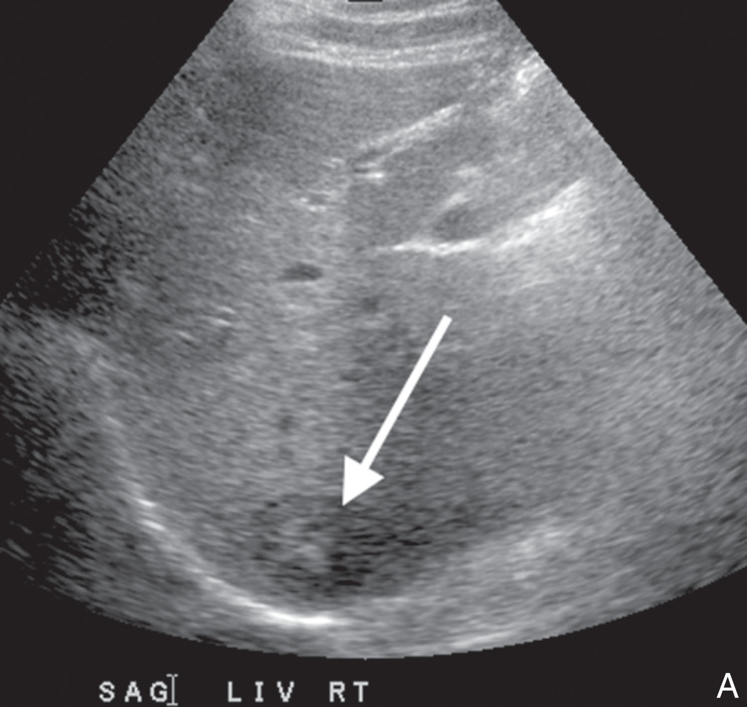 Fig. 18.3, (A) With the patient supine, the liver mass (arrow) is 15 cm deep. (B) The patient is now in the left lateral decubitus position, the liver has fallen forward, and the same mass (arrow) is now only 7 cm deep. An easy, successful biopsy showed metastatic disease from a pancreas primary.