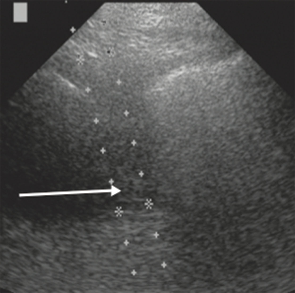 Fig. 18.22, Biopsy of a pleural-based lung mass. Although a noisy image, the break in the white line, which represents the pleura, helps to locate the mass. The arrow points to the needle tip. This was an adenocarcinoma.