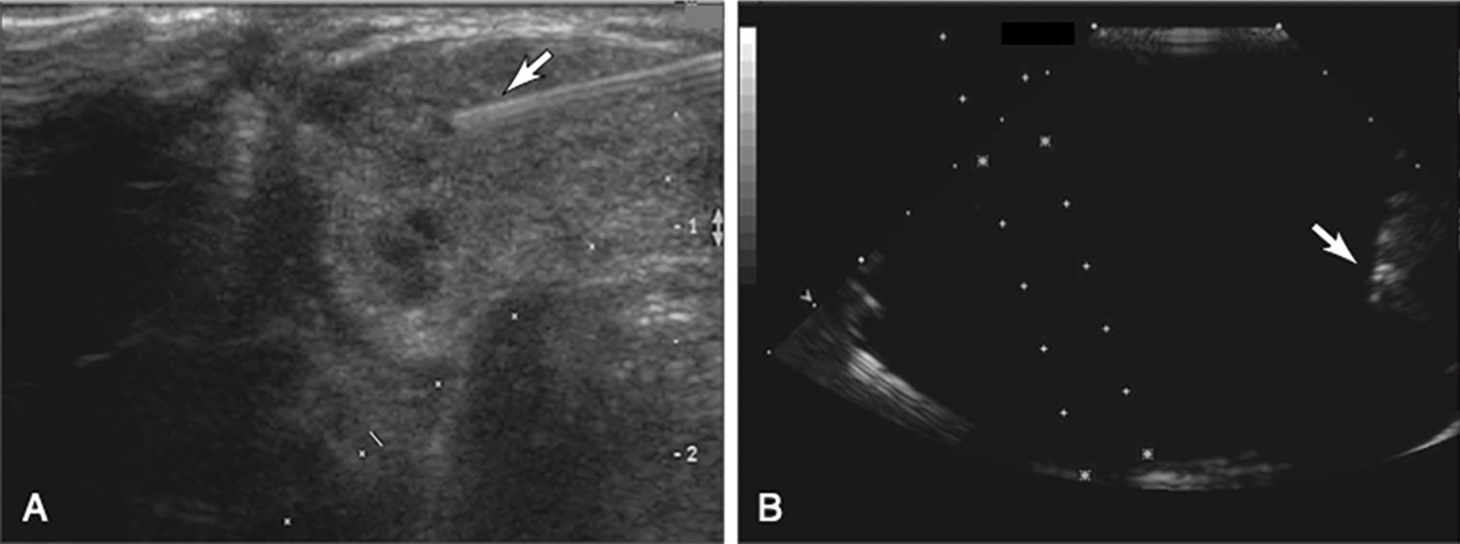 Fig. 18.24, (A) The arrow points to the needle, which appears to be deviating. In fact, the guide setting on the transducer does not match the setting on the unit. (B) The bracket was attached backward. When the needle is inserted (arrow) , it appears from the opposite side of the screen.