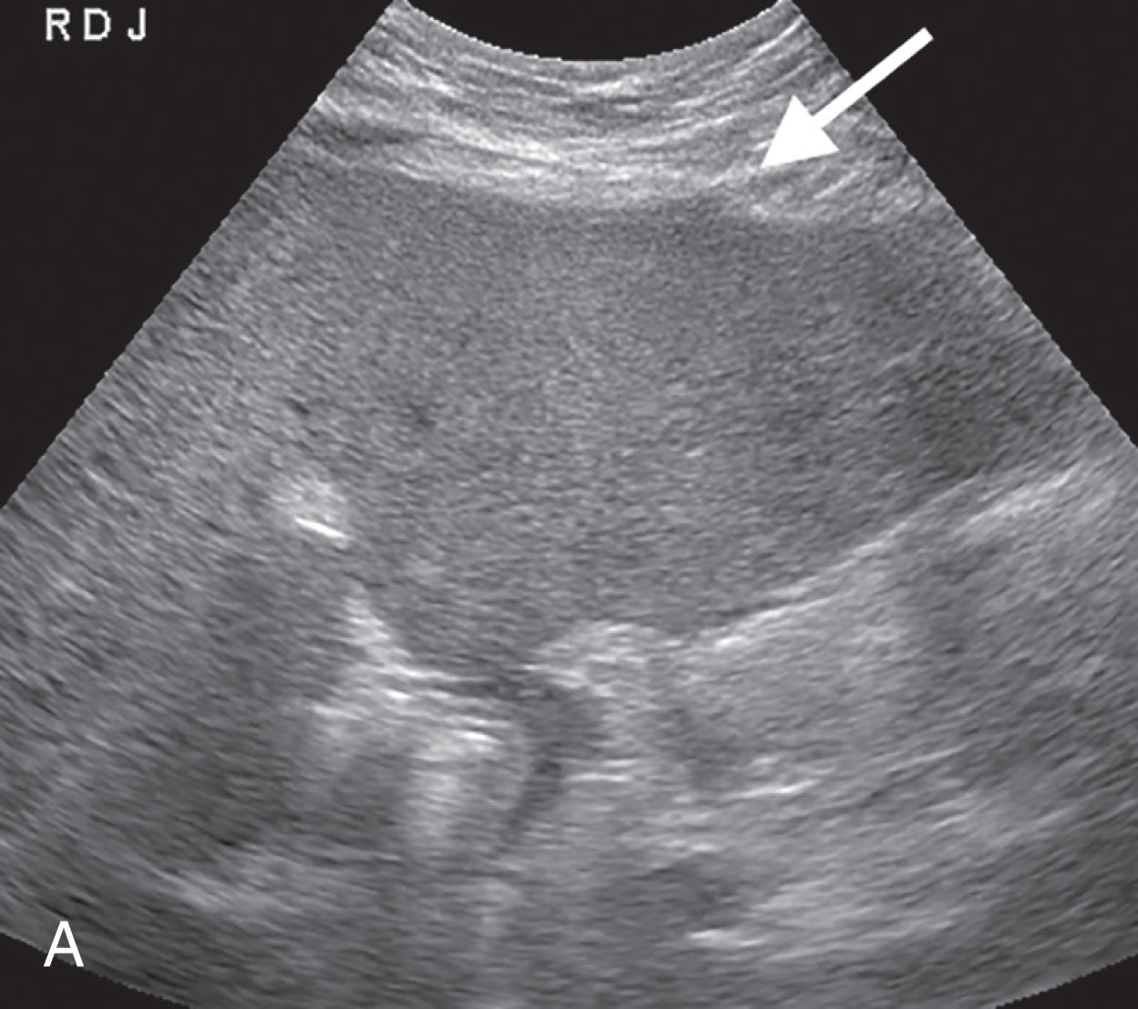 Fig. 18.4, (A) Although a mass was seen on a contrast magnetic resonance imaging (MRI), it was not appreciated by ultrasound. Using the MRI as a guide and looking for indirect signs, the area was identified. The arrow is pointing to a bulge in the capsule. (B) Color Doppler found areas of abnormal flow in the area of the bulge (arrows) . A successful biopsy diagnosed infiltrative hepatocellular carcinoma.