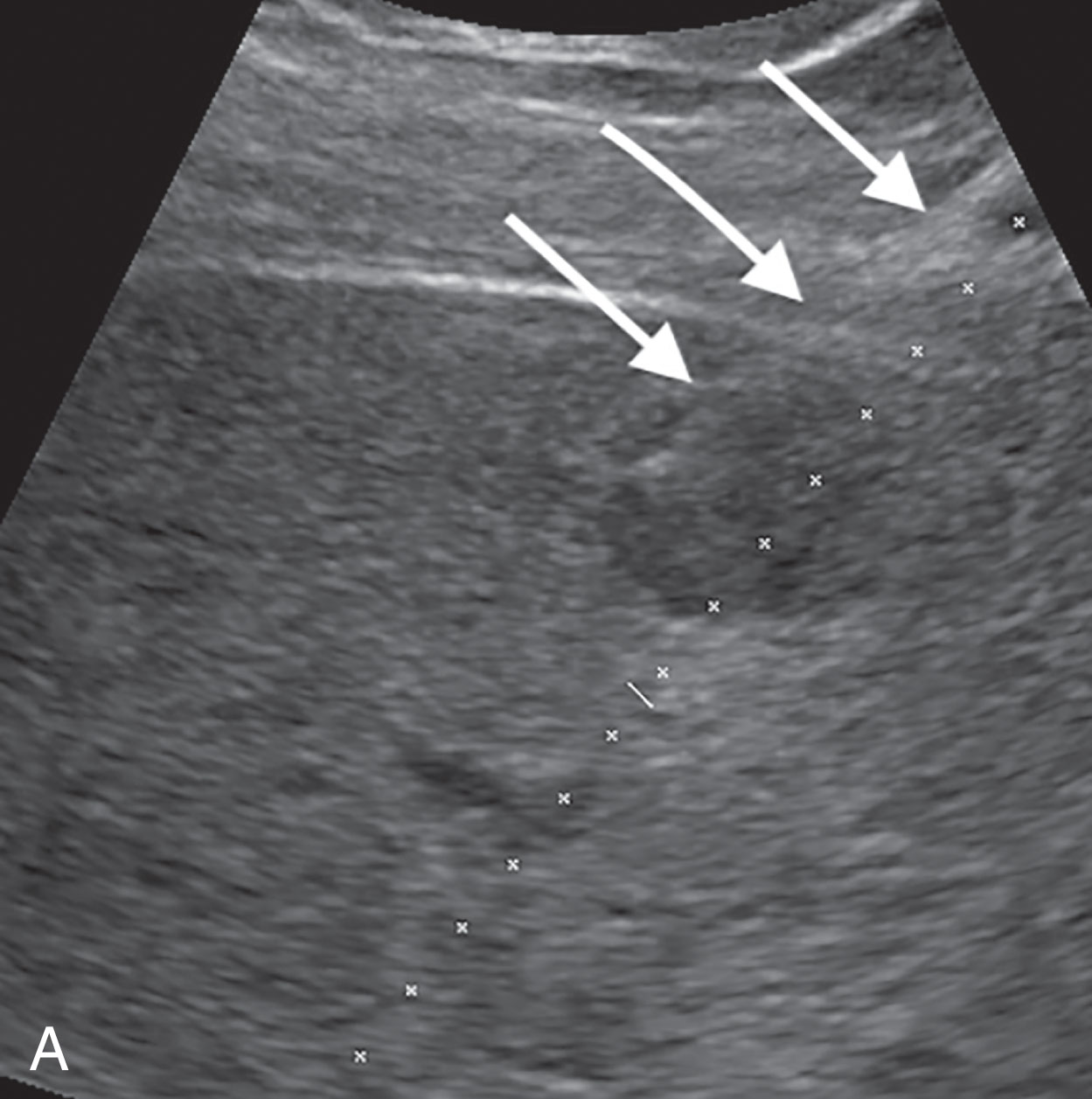 Fig. 18.5, (A) The needle (arrows) deviated from the projected path of the guide (dotted line) . (B) Because of the constant deviation of the needle from the projected path, the sonographer had to compensate by moving the transducer laterally so that the needle would pass through the center of the mass. Note that the projected path does not even go through the mass. A diagnosis of hepatocellular carcinoma was obtained.