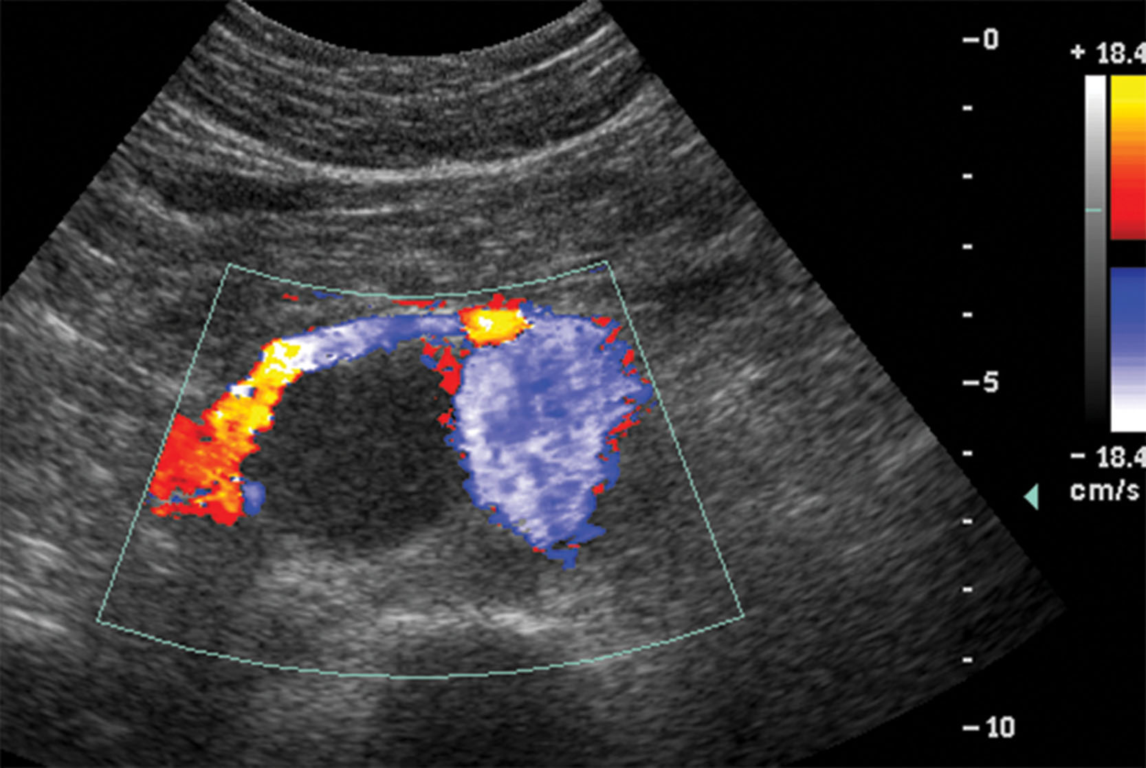 Fig. 18.7, This retroperitoneal lymph node could not be biopsied under ultrasound because of the vessels that surrounded it.