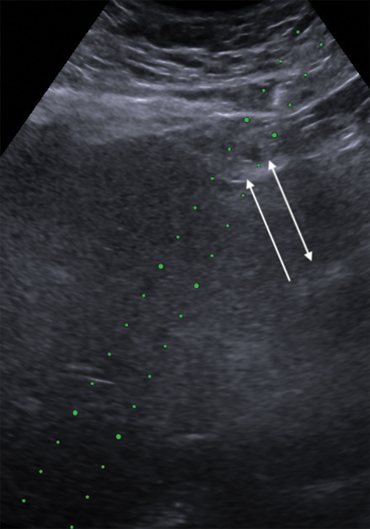 Fig. 18.10, Arrow shows where the needle is tenting the capsule. The double arrow points to the needle tip.