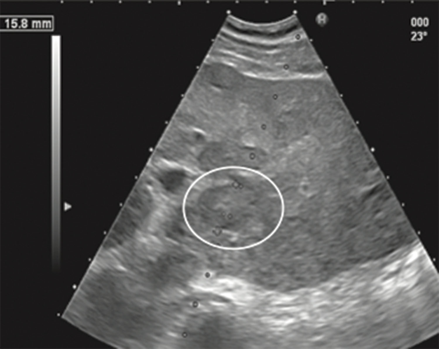 Fig. 18.11, The sonographer measured the lesion (calipers in circle) to determine the size of the core needle to be used. The diameter of the lesion along the needle path is 15.8 mm, so a 15-mm throw is needed to stay within the lesion.