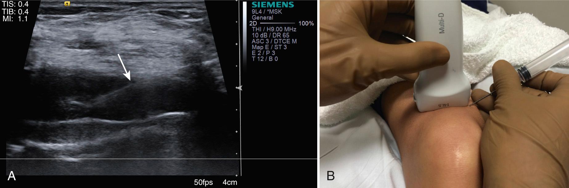 FIG 15.1, Knee Joint Effusion