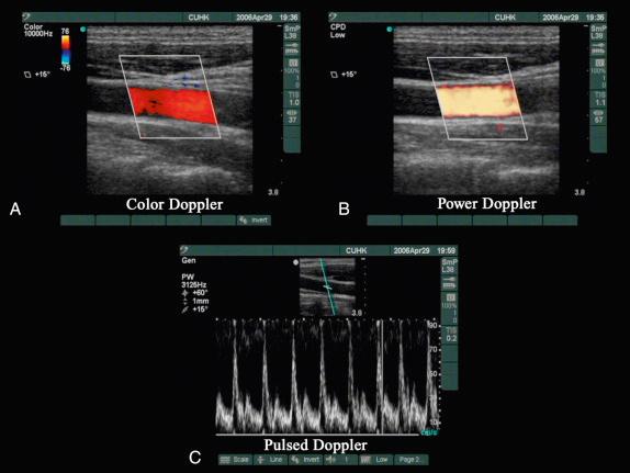 FIGURE 43.2, Doppler ultrasound. A, Color Doppler. B, Power Doppler. C, Pulsed Doppler.