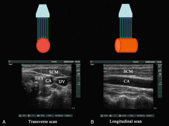 FIGURE 43.5, Axis of scan. A, Transverse scan. B, Longitudinal scan. CA, carotid artery; IJV, internal jugular vein; SCM, sternocleidomastoid muscle; THY, thyroid.