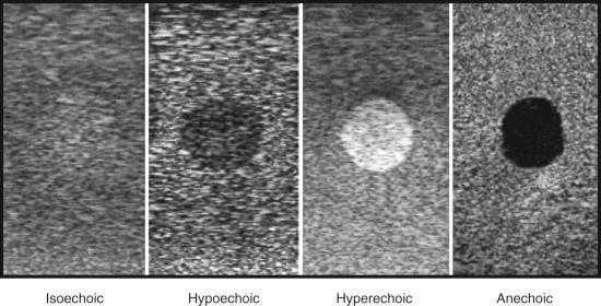 FIGURE 43.6, Schematic diagram to demonstrate the relative echogenicity of various tissues.