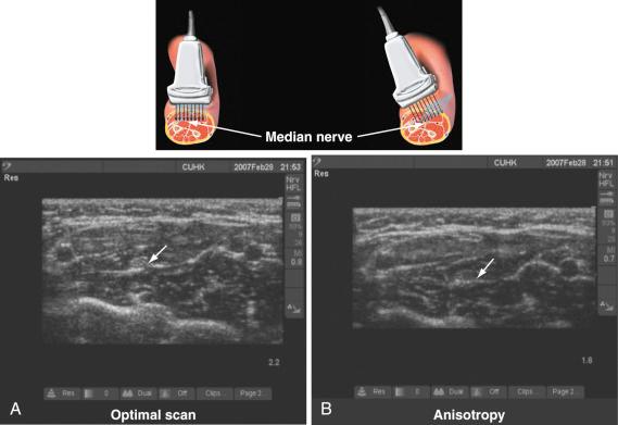 FIGURE 43.9, Anisotropy. Note how a small change in the angle of the ultrasound beam from the neutral position ( A ) has affected the visibility of the median nerve ( white arrow, B ) in the forearm.