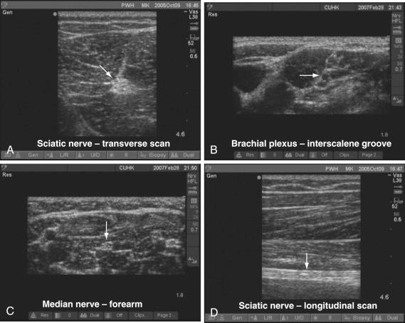 FIGURE 43.10, Ultrasound appearance of peripheral nerves. A, Transverse sonogram of the sciatic nerve in the thigh. B, Transverse sonogram of the brachial plexus in the interscalene groove. C, Transverse sonogram of the median nerve in the forearm. D, Longitudinal sonogram of the sciatic nerve in the thigh.