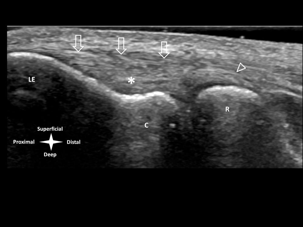 FIG 9.1, Lateral elbow—normal appearance. Long axis (coronal) image at the level of the lateral epicondyle (LE) . This demonstrates the normal echogenic fibrillar appearance of the triangular common extensor tendon (open arrows). The deeper hyperechoic fibers constitute the radial collateral ligament (*), which distally blends with the annular ligament (arrowhead) . C , Capitellum; R , radial head.