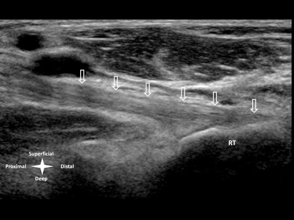 FIG 9.3, Anterior elbow—normal distal biceps tendon. Long axis (coronal) view of the biceps tendon (arrows) via the pronator window–medial approach. This demonstrates the normal echogenic fibrillar appearance of the distal biceps and attachment to the radial tuberosity (RT) . Dynamic imaging with pronation–supination can assist in identifying the separate components of the long head (proximal attachment) and short head (distal attachment).