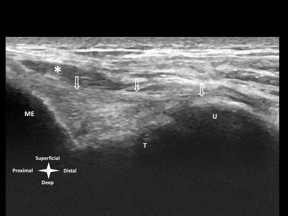 FIG 9.4, Medial elbow—long axis (coronal) image at the level of the medial humeral epicondyle (ME) . Deep to the hypoechoic flexor/pronator muscles (*) the normal margins of the hyperechoic fibrillar ulna collateral ligament can be seen (open arrows) traversing across the ulnohumeral joint (arrowhead) to insert distally at the sublime tubercle and proximal ulna (U) . T , Humeral trochlea.