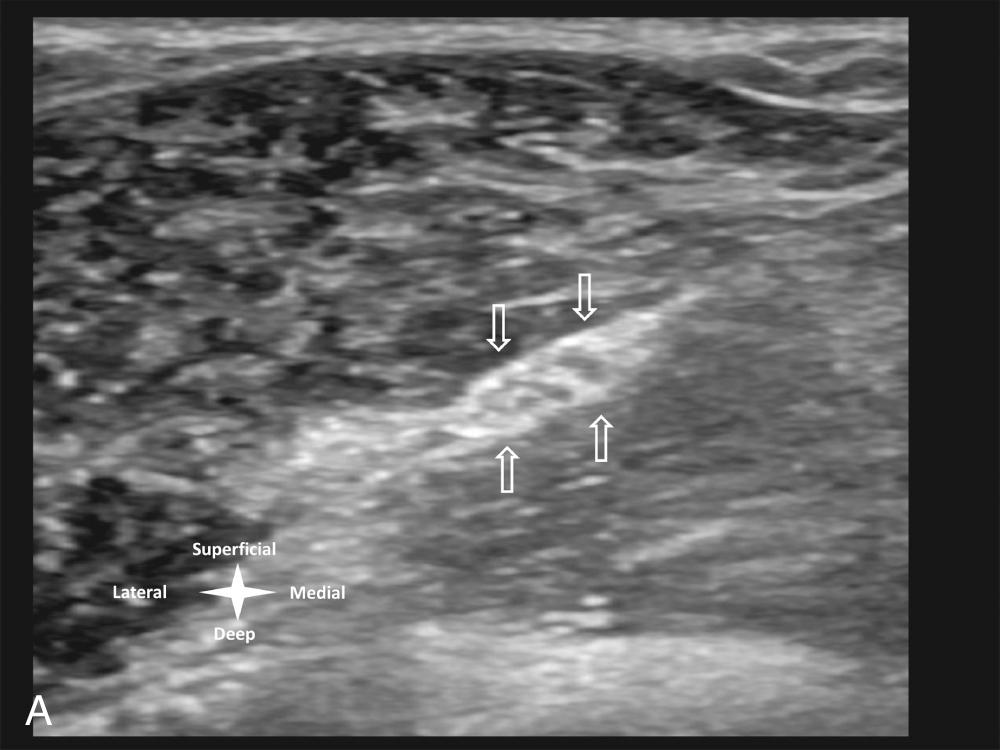 FIG 9.5, Normal nerves. (A) Short axis image of the radial nerve and (B) long axis (coronal) image of the ulnar nerve at the proximal elbow. Images demonstrate (A) the typical transverse honeycomb and (B) longitudinal tubular fascicular appearance of normal radial and ulnar nerves (between arrows ), representing hypoechoic nerve bundles surrounded by echogenic external and interfascicular epineurium.