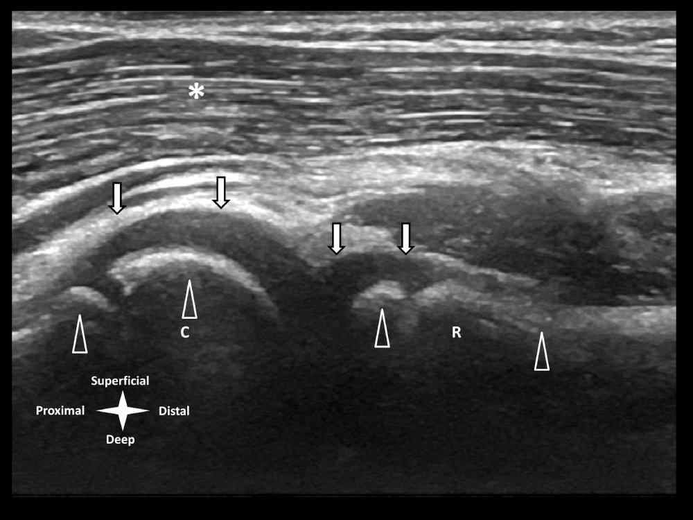 FIG 9.6, Anterior elbow. Long axis (sagittal) image of the anterior radiocapitellar joint in an 8-year-old girl. Overlying hypoechoic brachioradialis musculature demonstrates a normal striated or pennate echotexture (*) . Normal hyaline cartilage appears hypoechoic, with a smooth superficial margin (arrows) . Regions of cortical bone and ossification centers have a smooth echogenic margin, with posterior acoustic shadowing (arrowheads) . C , Capitellum; R , radius.