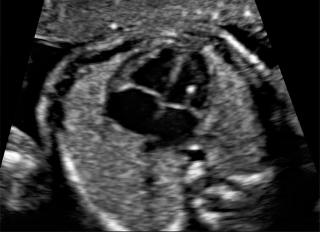 FIG. 10.1, Echogenic intracardiac focus.