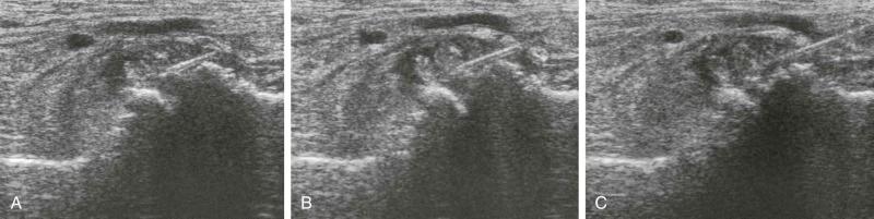 FIGURE 125-1, A - C , Ultrasound-guided injection of a tarsometatarsal joint. The needle tip is placed close to the joint space where the capsule bulges outward. Injection shows that the needle must be in the joint, as the images show the capsule enlarging and the new fluid confined to the joint. This is much easier to appreciate on a moving image.