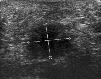 eFIGURE 125-1, On ultrasonography, Morton's neuroma appears as a hypoechoic area between the metatarsal heads, and there is point tenderness. The probe is placed beneath the foot, and the needle is introduced from the dorsum.