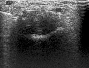 eFIGURE 125-2, Ultrasound-guided injection of an inflammatory mass arising from a midfoot joint. Note the irregular outline and the heterogeneous echo pattern.