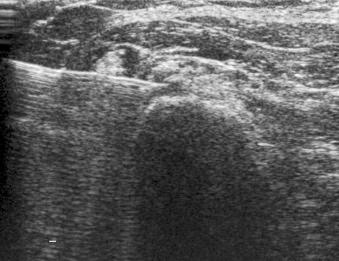 eFIGURE 125-3, Ultrasound-guided injection of the insertion of the gluteus medius and minimus at the greater trochanter. The horizontal needle approach means that the probe is well away from the puncture site and the needle is clearly seen up to and including the bevel.