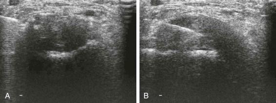 eFIGURE 125-4, Needle biopsy of a mass in the foot. This proved to be a schwannoma. A , Note that the needle entry is close to horizontal and that the needle is seen in detail. B , This image confirms that the specimen is taken from the center of the lesion.