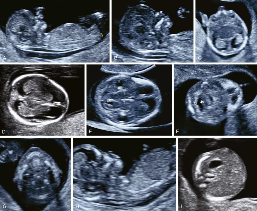 • Fig. 19.1, Anatomical planes used for first trimester fetal investigation. A, Crown–rump length. B, Fetal profile and nuchal translucency. C, Eyes and lenses. D, Lateral ventricles with choroid plexa (‘butterfly’ sign). E, Thalami (T) and mesencephalon (M) (plane used for head circumference (HC) measurements). F, Fourth ventricle (4v) with choroid plexus (C). G, Upper lip and palate. H, Diaphragm. I, Stomach. J, Abdominal wall with the umbilical cord insertion. K, Bladder and two umbilical arteries. L, Hand and fingers. M, Lower extremities. N, Kidneys. O, Spine.