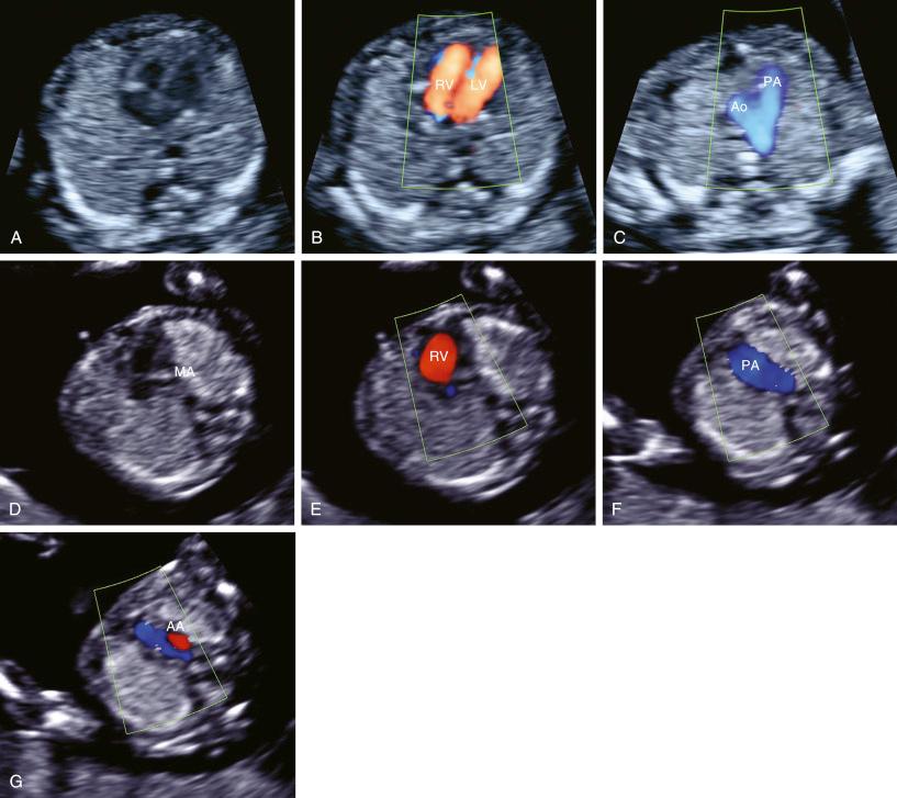 • Fig. 19.3, Axial planes used for examination of the heart ( A–C ). For comparison: hypoplastic left heart syndrome (HLHS) at 12 weeks ( D–G ). A, Four-chamber view. B, Ventricular filling by directional power Doppler. C, V-sign by directional power Doppler. D, HLHS. Mitral atresia (MA) on four-chamber view. E, HLHS. Right ventricle (RV) filling on four-chamber view. F, HLHS. Big pulmonary artery. G, HLHS. Reversed flow (red) in aortic arch (AA). Ao, Aorta; LV, left ventricle; PA, pulmonary artery.