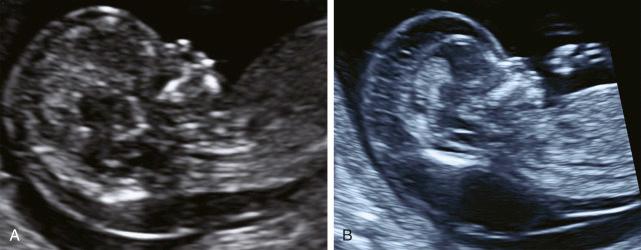 • Fig. 19.4, Increased nuchal translucency (NT). A, NT 6.0 mm, absent nasal bone. B, Severe hydrops.