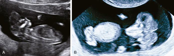 • Fig. 19.6, Acrania. A, Transabdominal scan at 13 weeks. B, Transvaginal scan at 12 weeks. ‘Milky’ amniotic fluid.