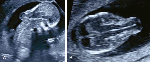 • Fig. 19.7, Encephalocele at 13 weeks. A, Posterior sagittal view. B, Axial view: herniation of the brainstem thought occipital bone defect.