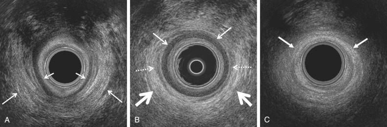 FIG 35-2, Transverse ultrasound images of the normal anal sphincter. Endoanal ultrasound images at three levels (upper sphincter, midsphincter, and caudal sphincter) at the level of the puborectalis muscle (PRM) shows the internal sphincter, intersphincteric fat, and external sphincter as separate structures. A, Endoanal ultrasound image: transverse image of the cephalad (upper) anal sphincter demonstrating the striated relatively echogenic U-shaped sling of the posterior PRM ( long arrows ) and the hypoechoic internal anal sphincter (IAS) ( short arrows ). Note that at this level the external anal sphincter (EAS) is absent. The innermost echogenic ring represents the rectal mucosa and interface with the transducer (central round black structure). B, Normal appearance on endonanal ultrasound of the anal sphincters at the midsphincteric level demonstrating the characteristic target or layered appearance. The inner echogenic ring represents the mucosa and interface with the transducer, the IAS is the subjacent markedly hypoechoic ring ( thin arrows ) and the outermost ring represents the EAS ( thick arrows ) and is typically either hyperechoic or of mixed echogenicity. Wispy hypoechoic curvilinear strands with a striated appearance ( dotted arrows ) between the IAS and EAS represent the longitudinal muscle layer. C, Endoanal ultrasound image: transverse image of the normal caudal or distal anal sphincter image where the echogenic EAS ( arrows ) extends beyond the IAS representing the superficial portion of the EAS.