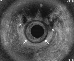 FIG 35-3, Sphincter tear. Endorectal axial ultrasound image demonstrating an intact hypoechoic internal anal sphincter ( arrows ), but disruption of the anterior aspect of the external anal sphincter ( arrowheads ) from the 11 o'clock to the 3 o'clock position.