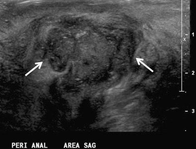 FIG 35-4, Abscess. Sagittal ultrasound image of the ischioanal fat demonstrates a complex fluid collection ( arrows ) consistent with perianal abscess.