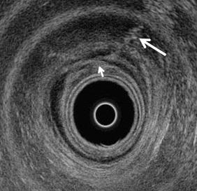 FIG 35-5, Fistula. Endorectal axial ultrasound image showing disruption of the anterior aspect of the external anal sphincter highlighted by echogenic air bubbles ( long arrow ). The fistula extends into the intersphincteric space but not through the hypoechoic internal anal sphincter (IAS). However, the IAS appears disrupted anteriorly at the 11 to 12 o'clock position ( short arrow ).