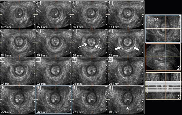 FIG 35-6, Multiplanar three-dimensional transperineal ultrasound image of the anal canal. Multiple axial images of the anal canal depicting the cross section of the anal canal structures from the caudal (1) to the cranial (16) sections. The cranial images show absence of the anterior portion of the external anal sphincter at the level where the puborectalis muscle sling ( asterisk ) is normally visualized behind the anal canal ( asterisk ). The internal anal sphincter ( thin arrows ) and external anal sphincter ( thick arrows ) are well visualized on the crosshair at the midlevel of the anal canal.