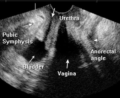 FIG 35-7, Normal pelvic floor anatomy visualized on the sagittal plane during transperineal ultrasound imaging. Annotated normal sagittal reconstructed image of three-dimensional transperineal ultrasound shows the key structures that are evaluated by this technique. The osseous structures such as the symphysis are echogenic ( white ) whereas the fluid-filled bladder is anechoic ( black ). Gas in the vagina creates posterior shadowing, which may partially obscure structures.