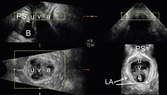 FIG 35-9, Rendered three-dimensional (3D) image of the normal pelvic floor hiatus demonstrating symmetry of the levator ani muscles. Transperineal pelvic floor 3D sonography: multiplanar view with rendered transverse plane. The four parts of the figure show the midsagittal plane (A), coronal plane (B), axial (transverse) plane (C), and rendered 3D axial (transverse) plane (D). The normal anatomic orientation of pelvic structures is shown in the midsagittal, axial, and rendered planes. The rendered axial image is taken across the plane of “smallest dimension,” and the outline of the inferior pubic rami is seen below the pubic symphysis. Rendered reconstruction in an axial plane shows symmetric levator ani muscles (LA and arrows ). a, anal sphincter; B, bladder; PS, pubic symphysis; u, urethra; v, vagina.