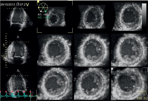 Figure 2.1, Multi-beat 3D echocardiographic imaging. Multislice image showing nine short-axis planes of the left ventricle created from six subvolumes from six consecutive heartbeats.