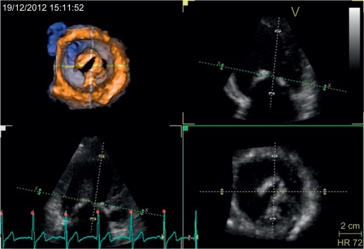 Figure 2.2, 3D echocardiography of a patient with mitral stenosis. Upper left panel shows the 3D image. Upper right and lower panels show 2D slices (by flexislice method) created from the 3D dataset. The accurate mitral valve area can be traced and measured from the 2D image.