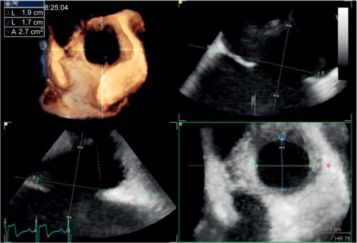 Figure 2.5, Transesophageal 3D echocardiography of a patient with an atrial septal defect. Upper left figure shows a 3D image, with the defect seen from the right atrium. By flexislice method, 2D plane images can be made from any plane preferable in the 3D dataset. Geometry and area of the defect can be accurately assessed to help choosing correct device for defect closure.