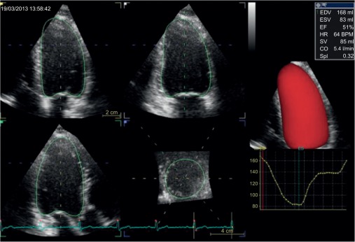 Figure 2.3, Surface rendering image. The left ventricle depicted by its surface as a solid 3D object (red) is derived from a manual correction of the semi-automated endocardial border detection in all three apical views. Left ventricular volume throughout the cardiac cycle is shown in the graph (lower right).