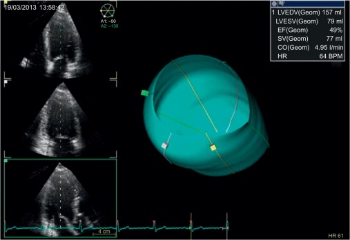 Figure 2.4, Surface rendering image. 3D image of the left ventricular cavity (blue).