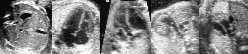 Fig. 74.1, Five short-axis views for CHD screening method during pregnancy as proposed by Yagel et al. 2